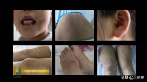2016年，四川10岁女娃被喂“鸡饲料”，惨遭养母虐待浑身60多处伤  第2张